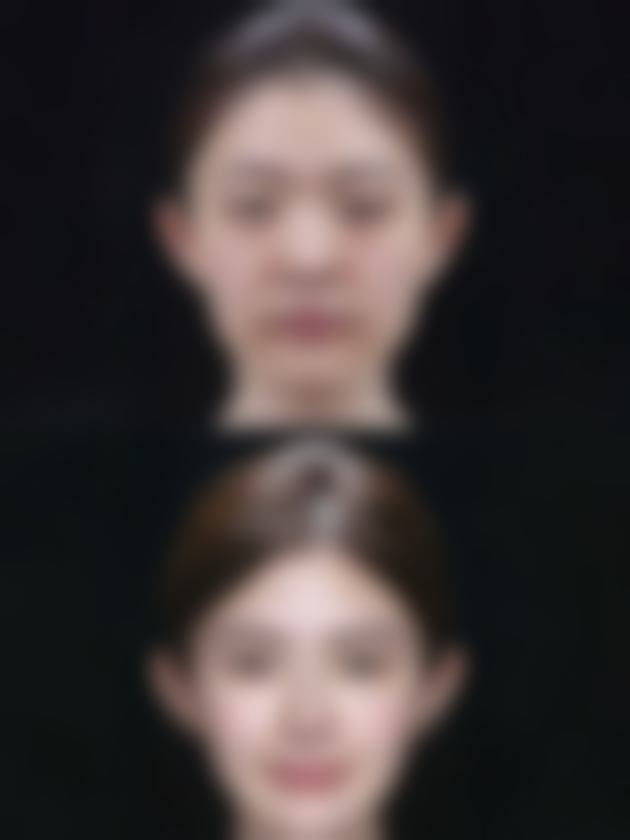 做完双眼皮手术眼角有增生怎么办？教你多招改善增生、恢复眼部美观