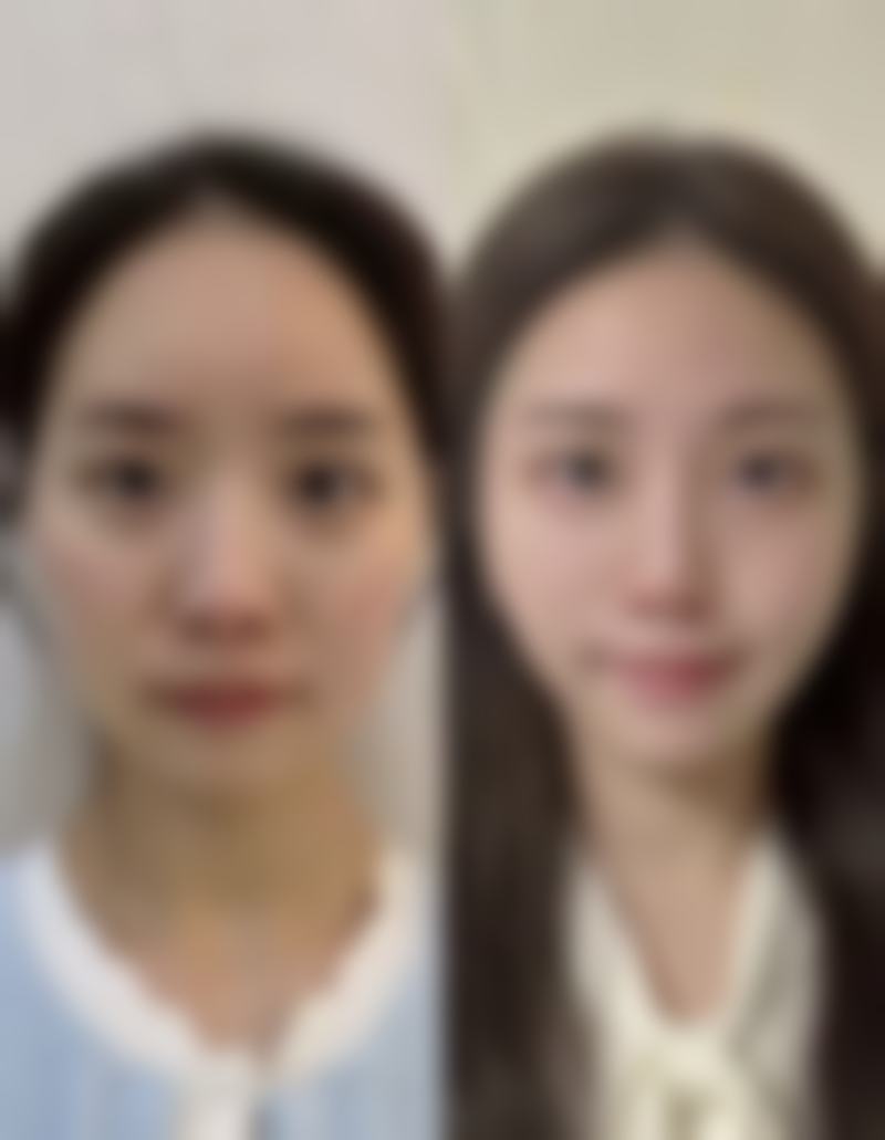 四、全切双眼皮宽修复窄的设计重点