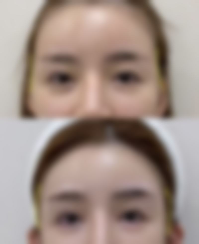 二、全切双眼皮宽修复窄的时机