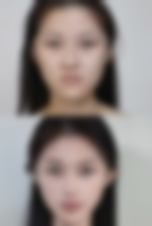 二、肚子抽脂皮肤松弛的术后护理建议