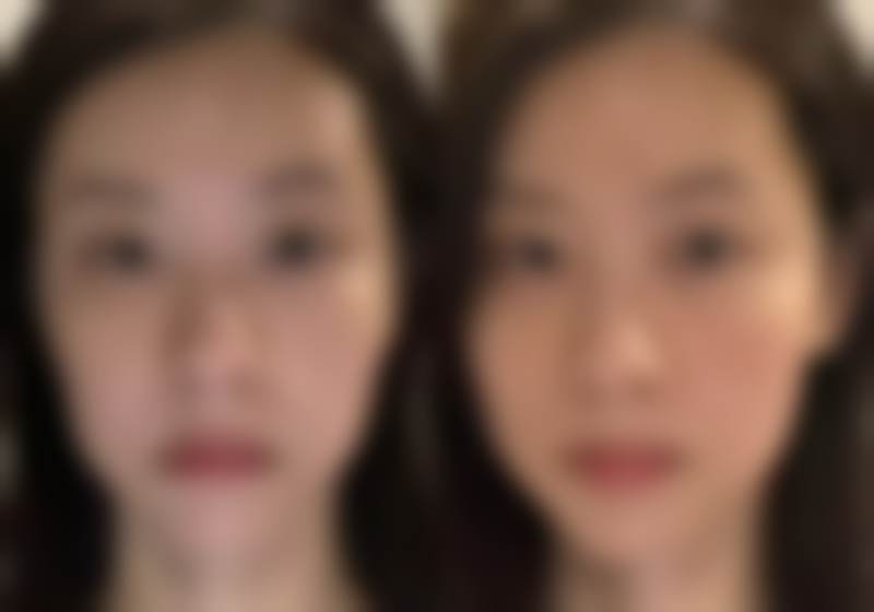 肚子抽脂皮肤松弛怎么办？掌握这些方法让恢复速度快人一步！ 