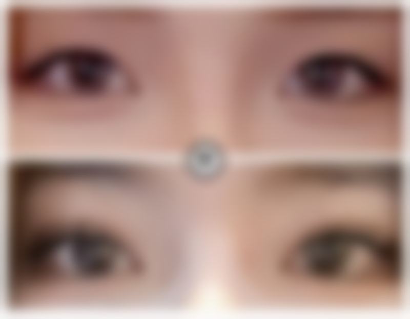 一、了解做完双眼皮手术眼角有增生的原因