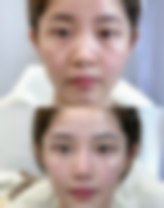 二、埋线双眼皮一个宽一个窄的修复时间与护理建议