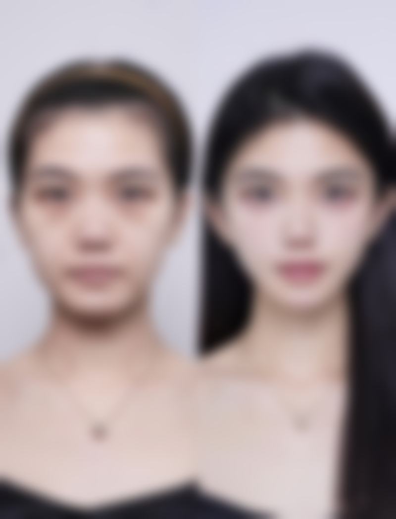 下颚错位怎么矫正？掌握专业与自我矫正步骤图，轻松应对错位难题！ 