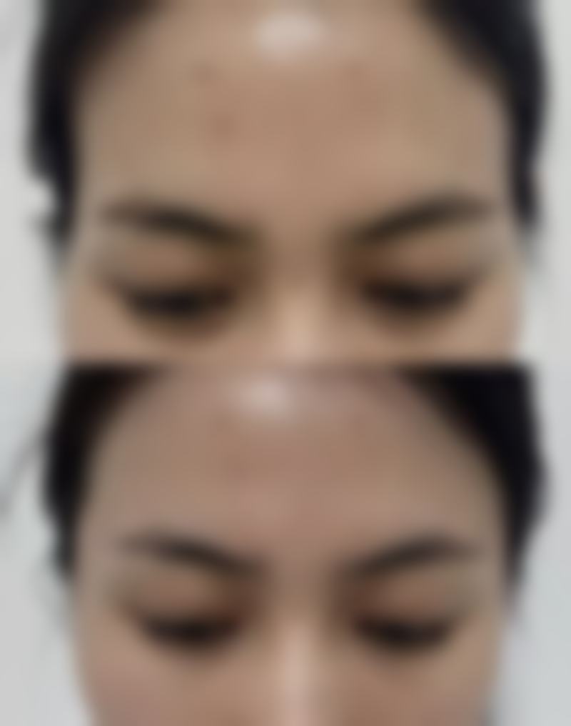 四、如何科学进行吸脂手术