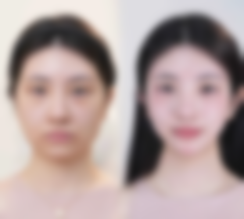 眼睛按摩仪对去除眼袋有没有作用呢？深度剖析其效果与适用情况！ 