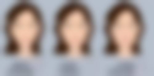 四、不同眼袋类型的超声炮适用性及更优方案