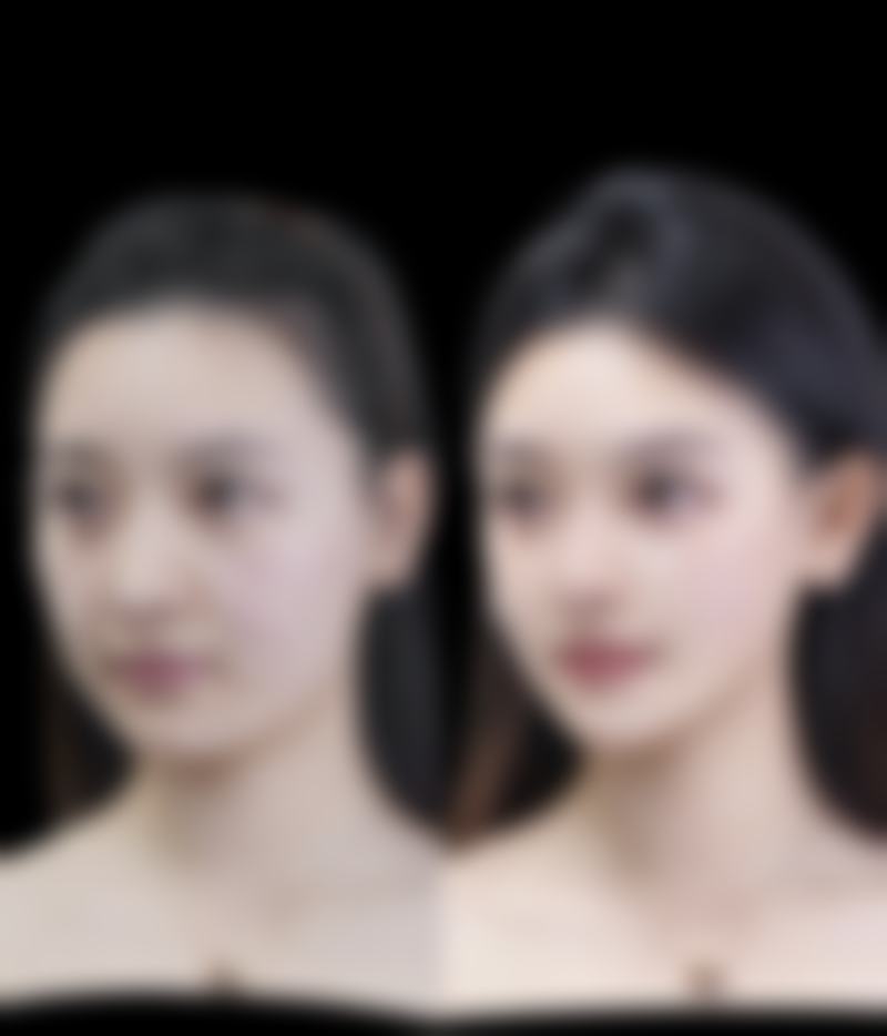 隆鼻整形后遗症有哪些？感染、移位、形态不佳等症状及应对方法揭秘！ 