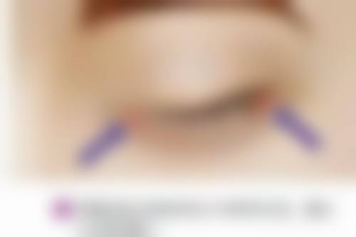 疤痕色素沉着怎么除掉？多种方法助你淡化色素、恢复均匀肤色！ 