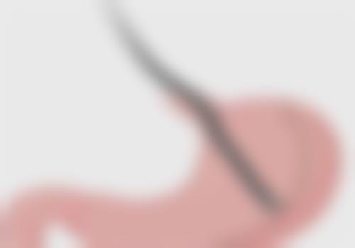 疤痕增生怎样去除好？综合治疗方案助你彻底治好疤痕增生！ 