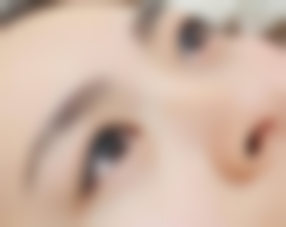 四、线提升隆鼻与其他鼻整形方式的对比