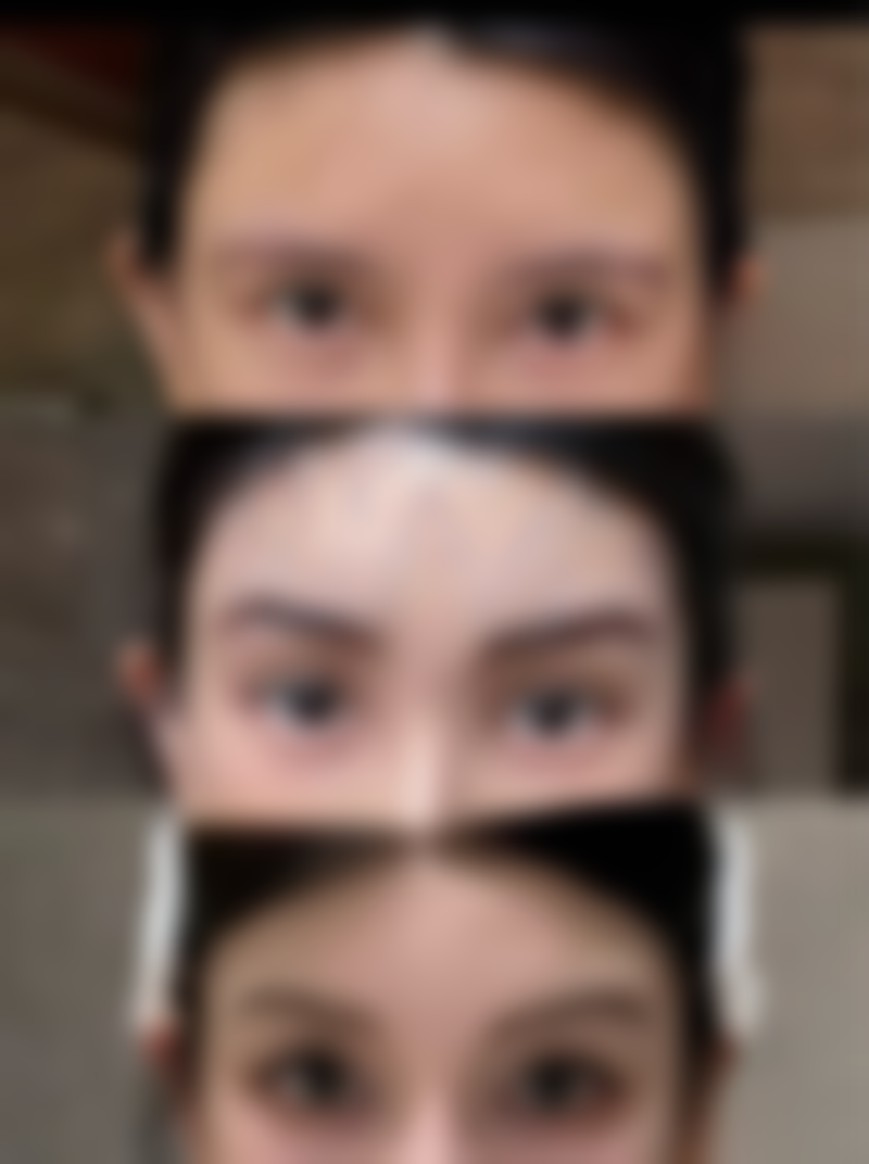 疤痕疙瘩很痒越长越大怎么办？多种有效方案助你控制发展、缓解不适 