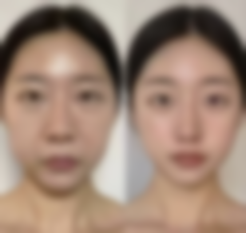 二、常见矫正方案对比