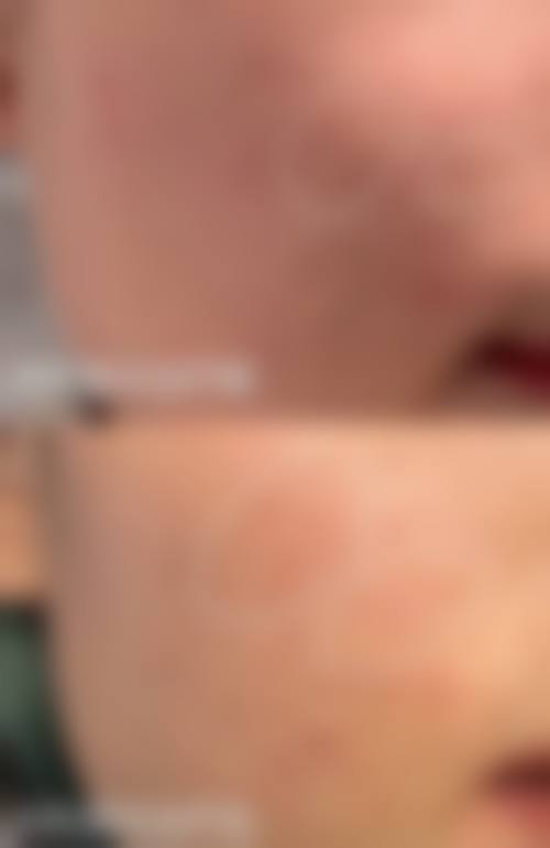 四、疤痕增生激光治疗的流程和注意事项