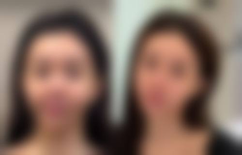 光速去眼袋怎么做的？权威揭秘激光、光纤等去眼袋方法及全程注意事项 