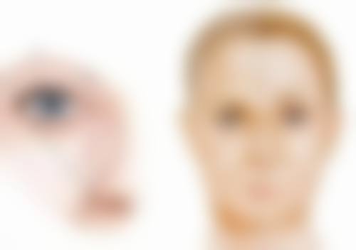 疤痕体质是不是不可以割双眼皮？专业解析及应对方案助你安心变美 