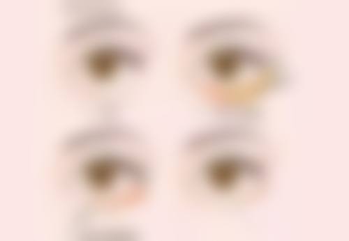 四、手术治疗消除凹陷疤痕