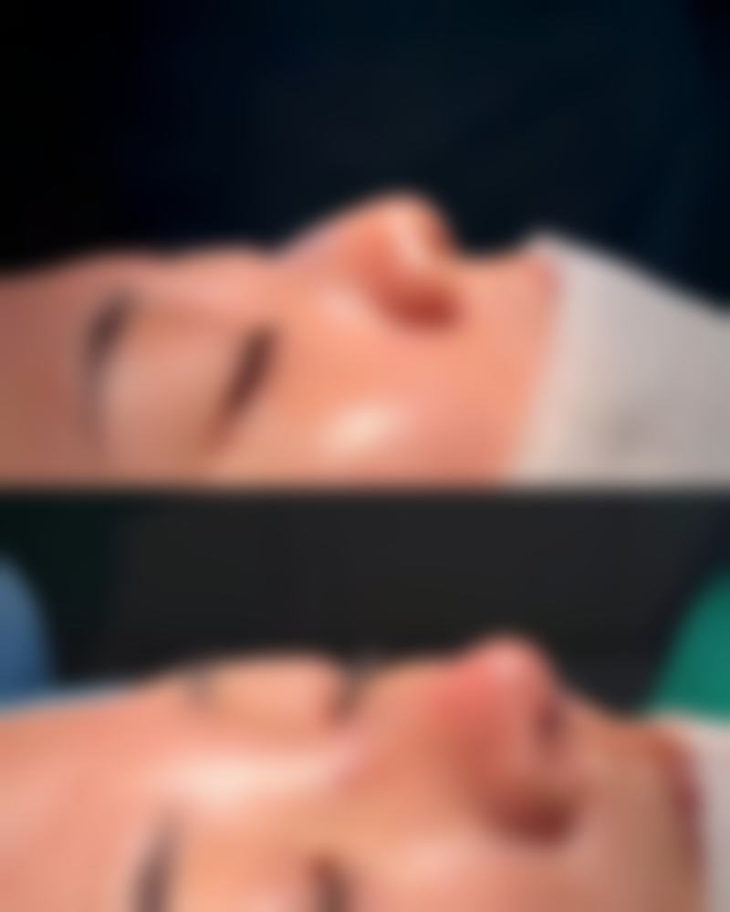 二、药膏缓解修复凹陷疤痕