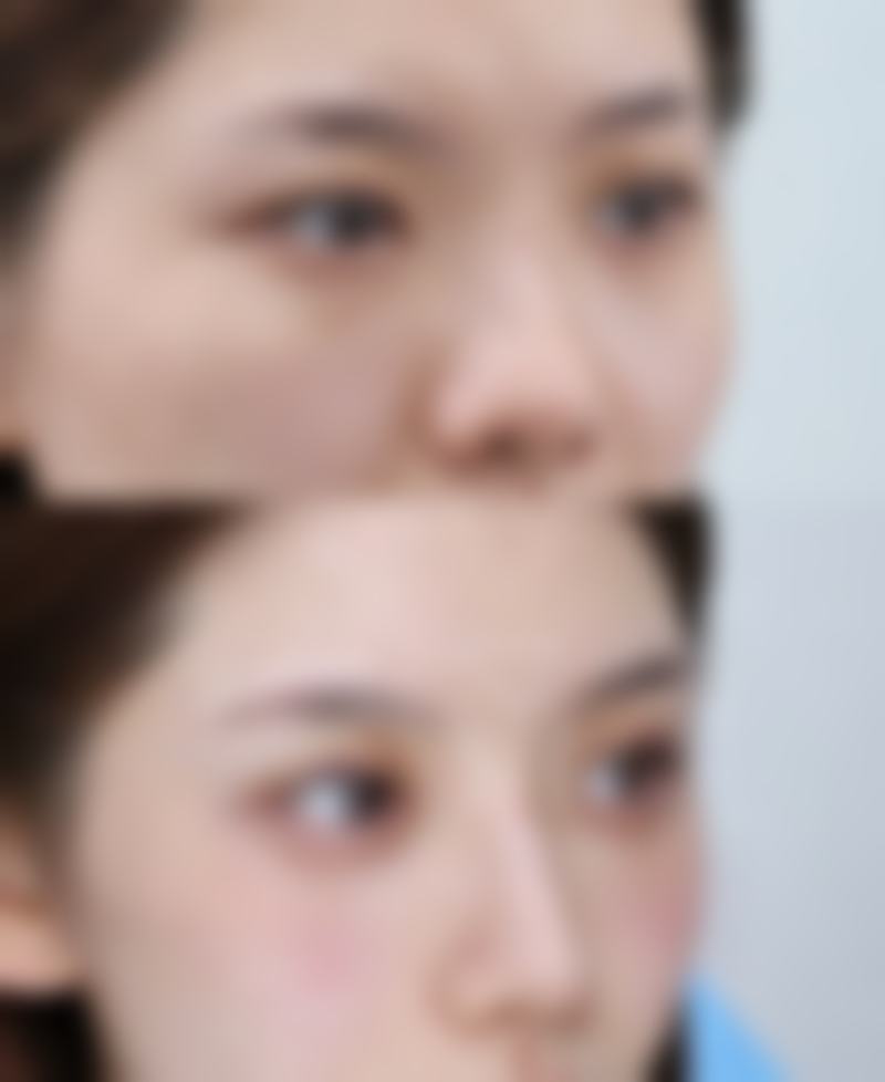 一、激光去眼袋怎么做的