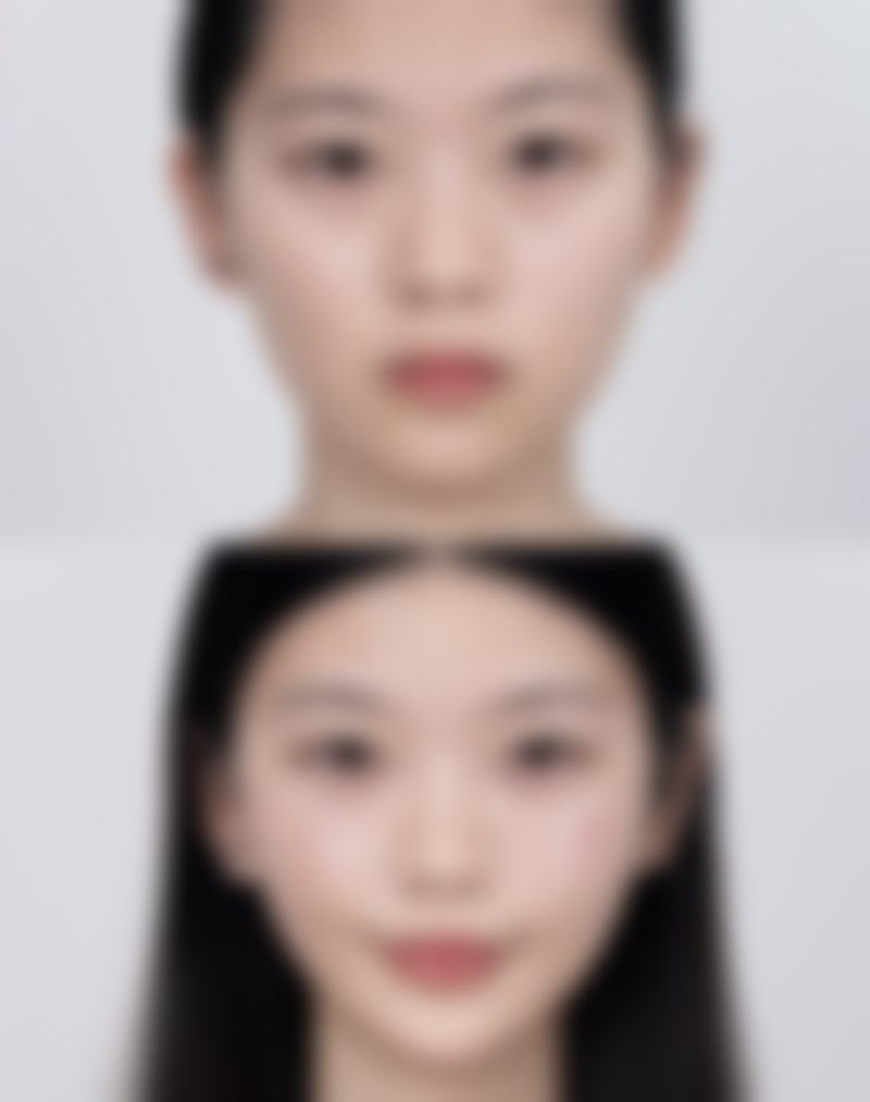 三、不同类型前胸疤痕疙瘩的治疗方案