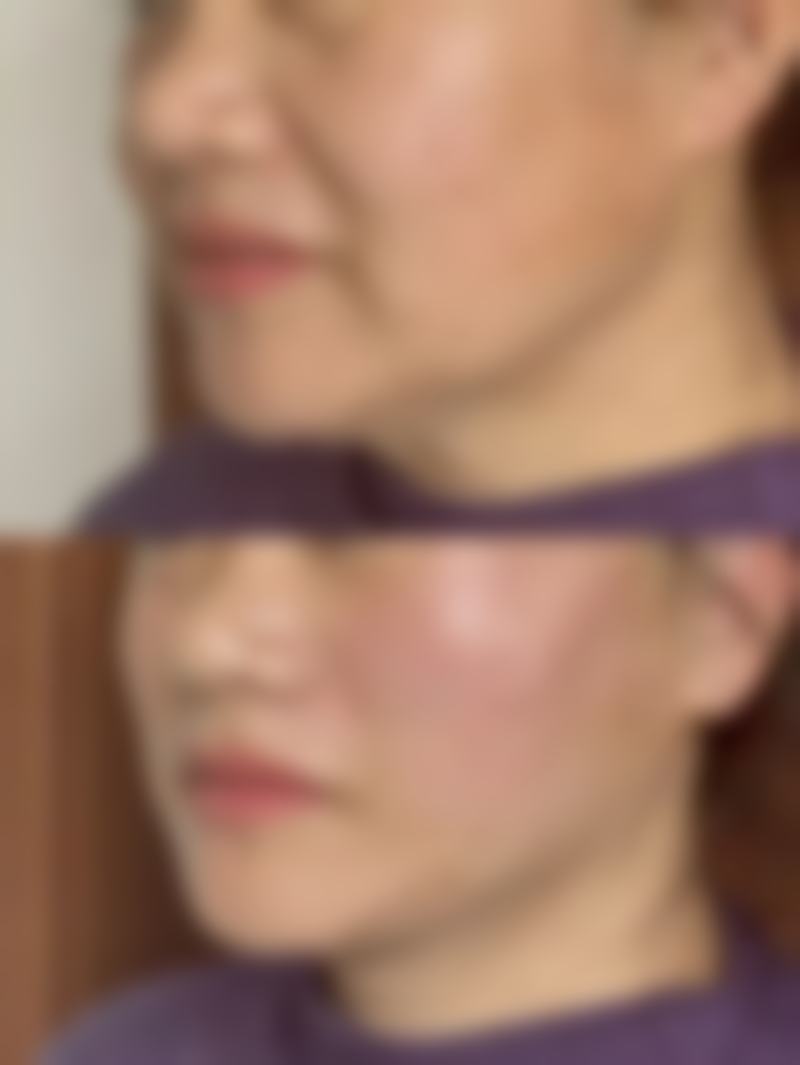 二、光纤去眼袋怎么做的