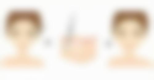 五、打完瘦脸针后不同睡姿的影响