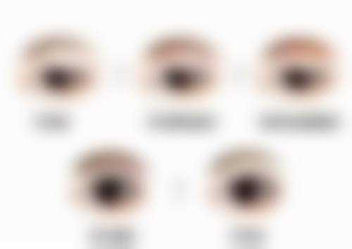 五、做双眼皮开眼角拆线后不适多久能缓解