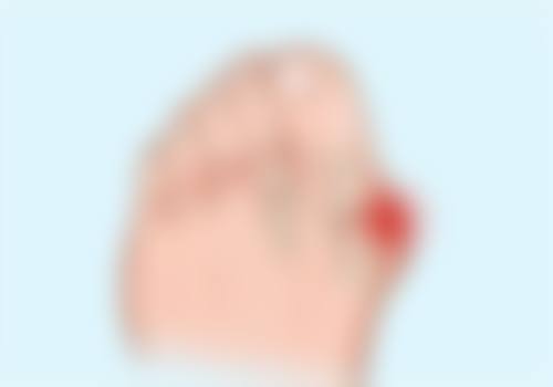 三、加速淤青消退的医美辅助方案