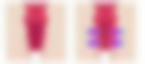 一、双眼皮手术发炎留疤的关键因素