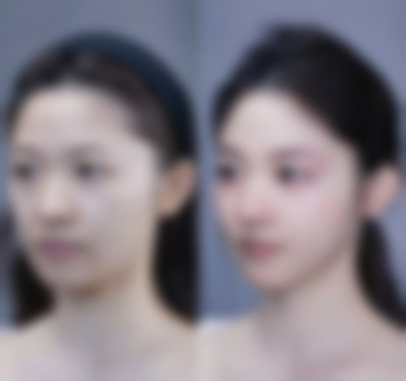 一、大综合隆鼻的概述