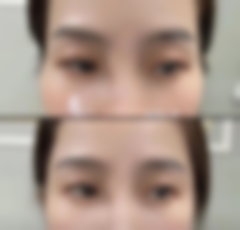 三、可能影响疤痕形成的其他因素