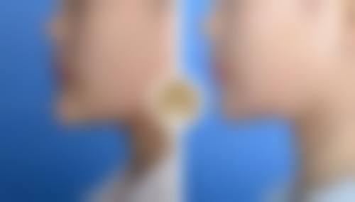 三、影响肋骨隆鼻吸收率的因素