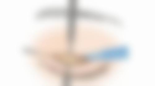 二、肋骨隆鼻的吸收情况