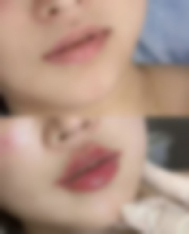 二、红霉素软膏可以祛眼袋吗？看看眼袋形成的原因