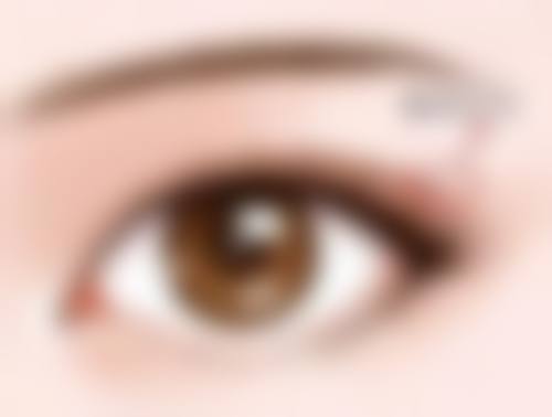 六、结尾：全切双眼皮修复多长时间才能正常