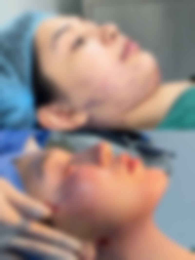 五、全切双眼皮修复过程中的注意事项