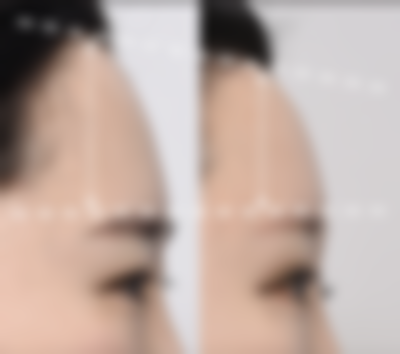 一、什么土办法可以去眼袋