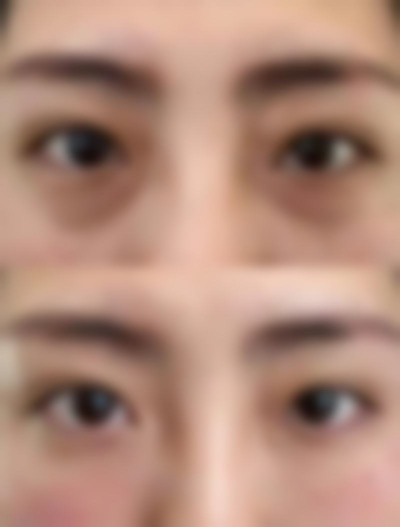 五、女人眼袋形成原因之肾脏疾病