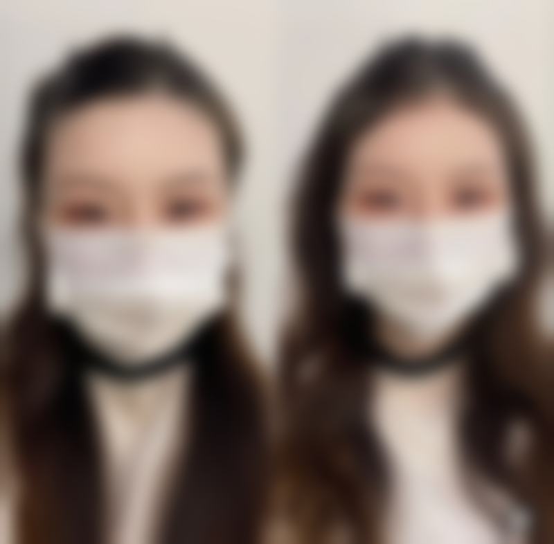 三、影响全切双眼皮修复时间的因素