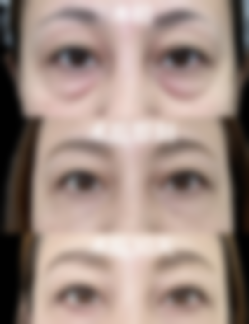 七、女人眼袋问题重度时的处理