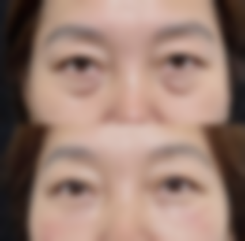 四、全切双眼皮正常饮食时间揭秘