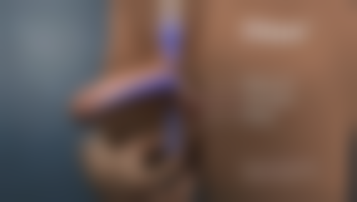 二、去眼袋手术后淤青正常的消除时间