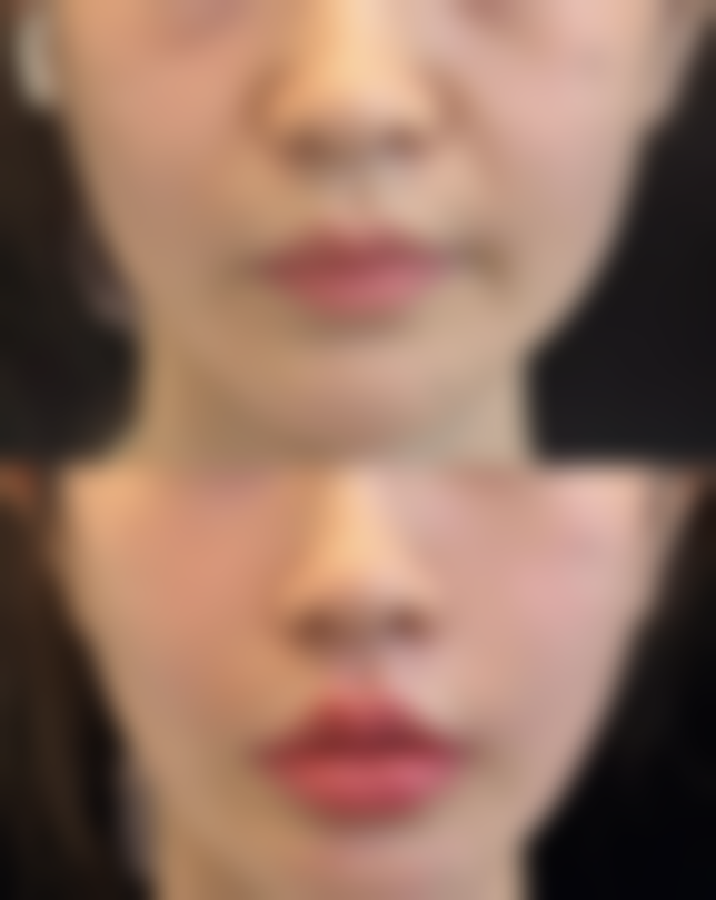 三、切眼袋手术可能导致泪沟更明显的情况