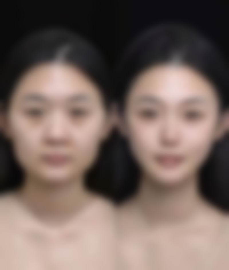 五、切眼袋手术改善泪沟的真实实例