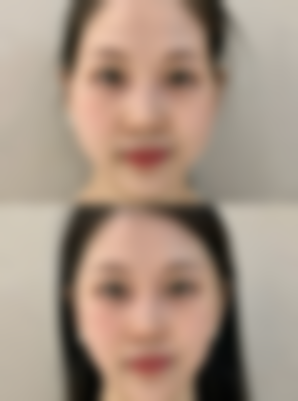 一、去眼袋按摩器的作用原理