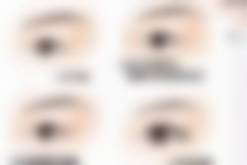 五、怎么样去眼袋有成效之手术治疗