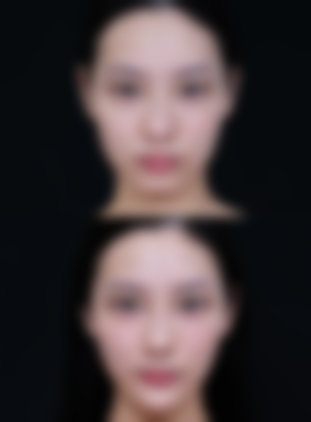 50岁的人眼袋好大又黑怎么办？改善生活方式、手术及电光治疗或能帮到你