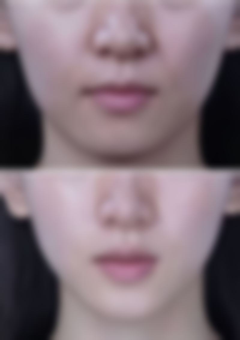 六、深蓝射频除皱的合理价格区间