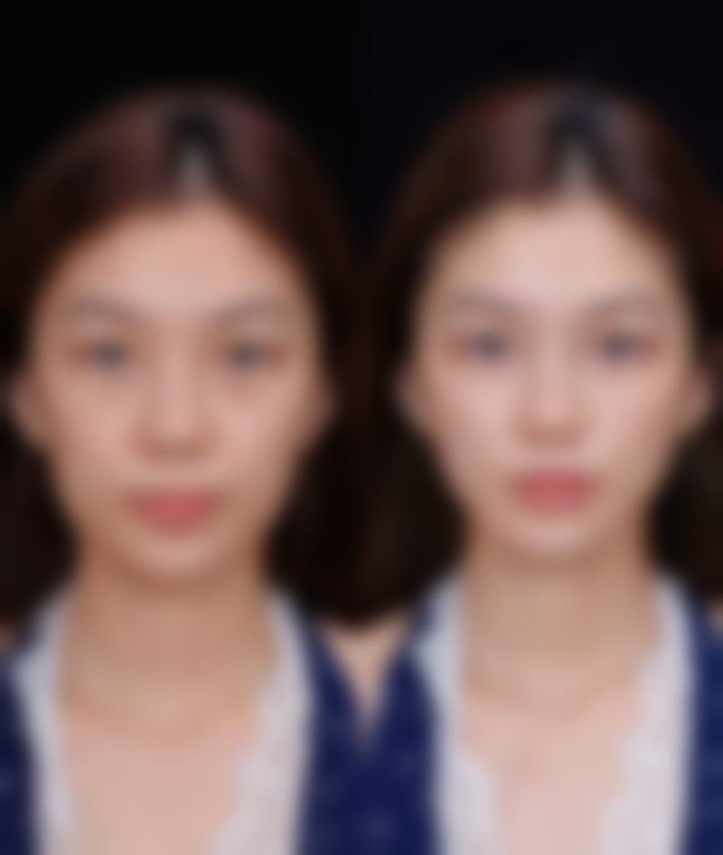 三、女生未成年阶段去除眼袋的建议