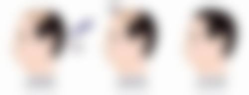 四、去增生疤痕怎么办之手术治疗法